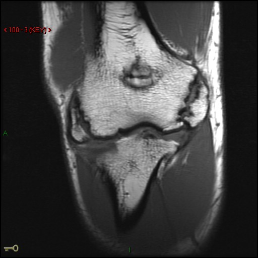 Figure 4 for case Ununited epicondylar fractures